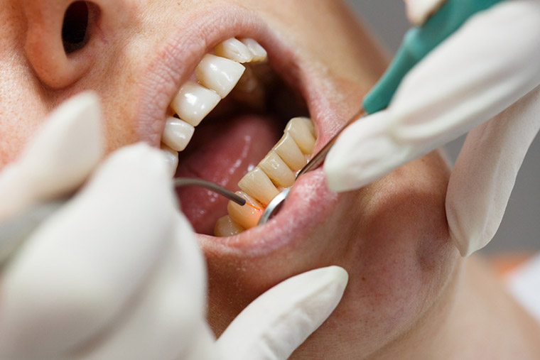 Zahnbehandlung mit dem Laser