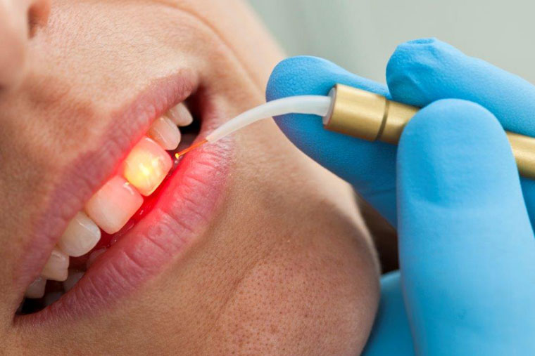 Laserbehandlung bei Zahnarzt Dr. Hoffmann