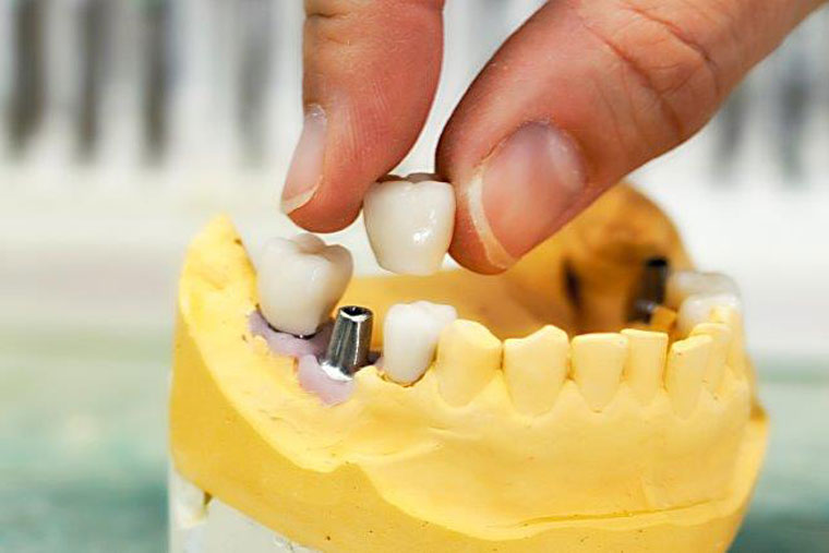 Zahn-Implantat